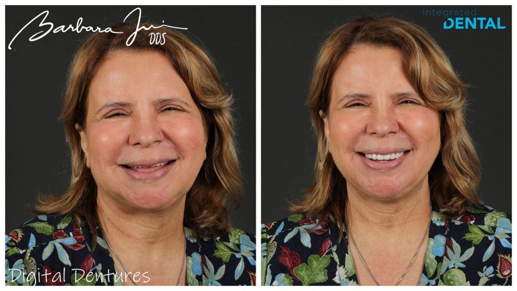 Custom Fit Dentures - integratedDENTAL - Woodbury, NY