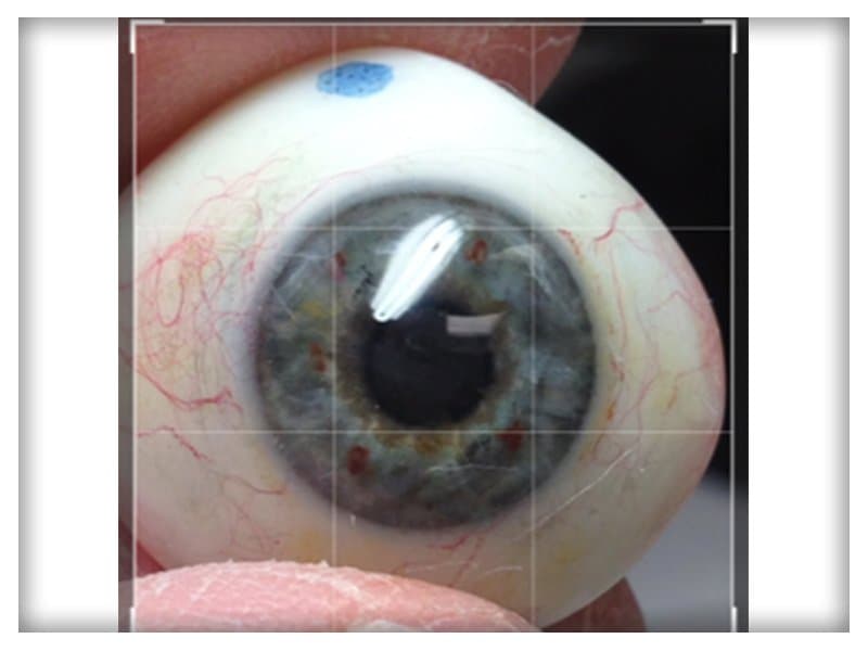 Before & After Toronto Eye Prosthetic Image Gallery - Hall & Associates ...