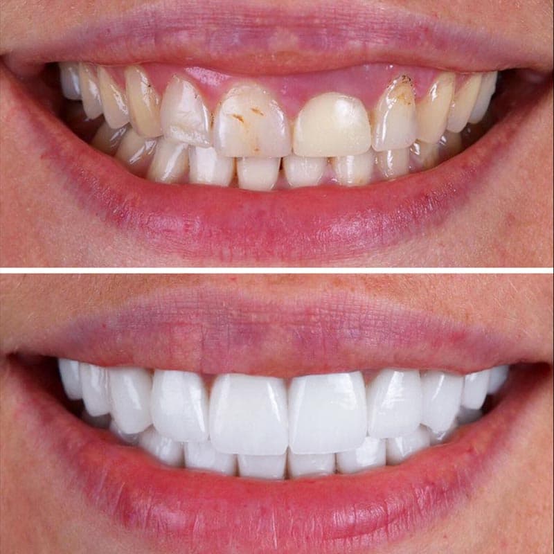 Veneers | Pro Dental | Porcelain Emax Veneers in London