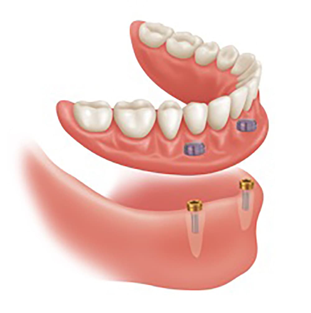 Implant Overdentures – Smile Zone Denture