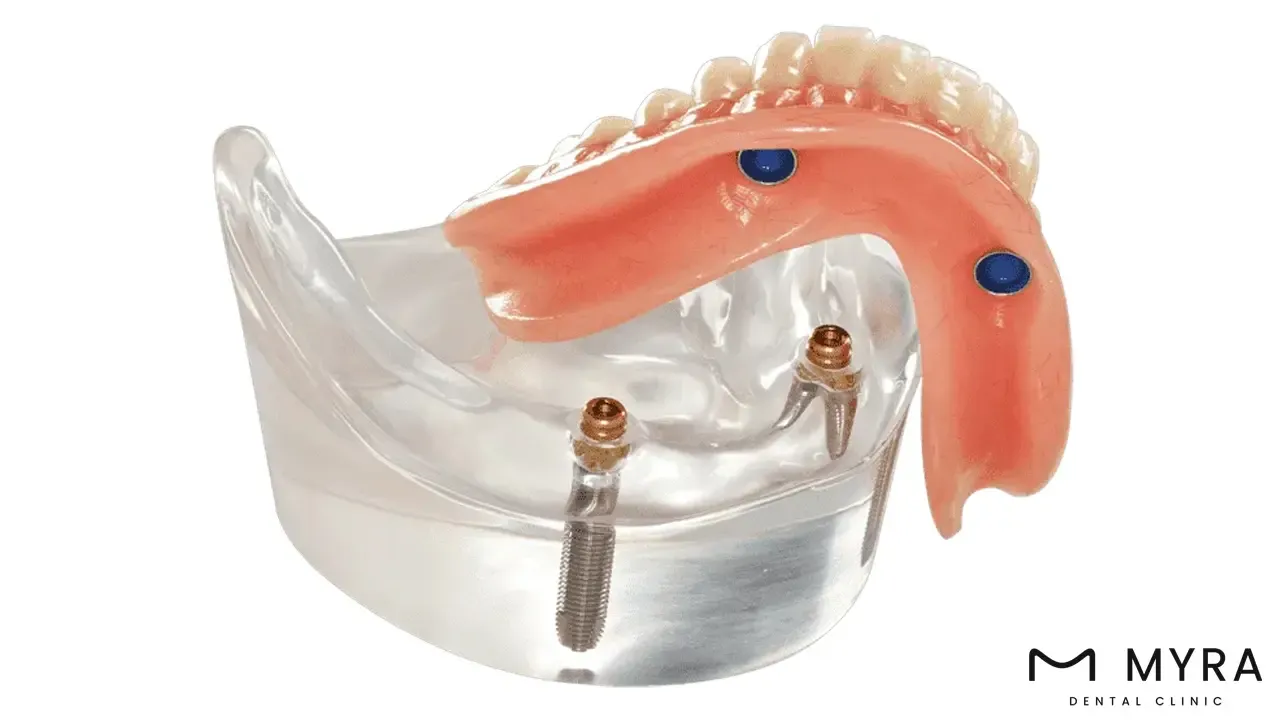 Dental Implant Overdentures: Definition, Types, Benefits, and Cost