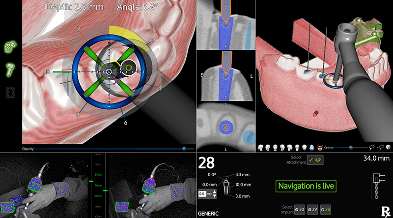 Learn More about the X-Guide Dynamic 3D Navigation System
