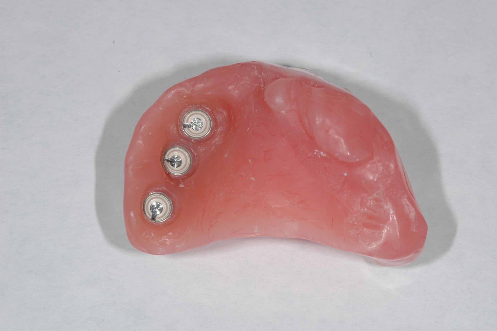 Rehabilitation of Oral Cancer Patients | Aragon Prosthodontics