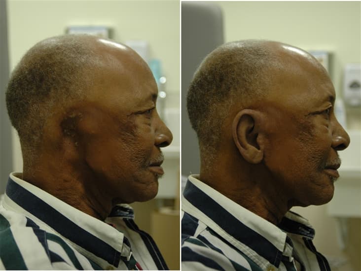 Prosthetic Ears - Center for Custom Prosthetics