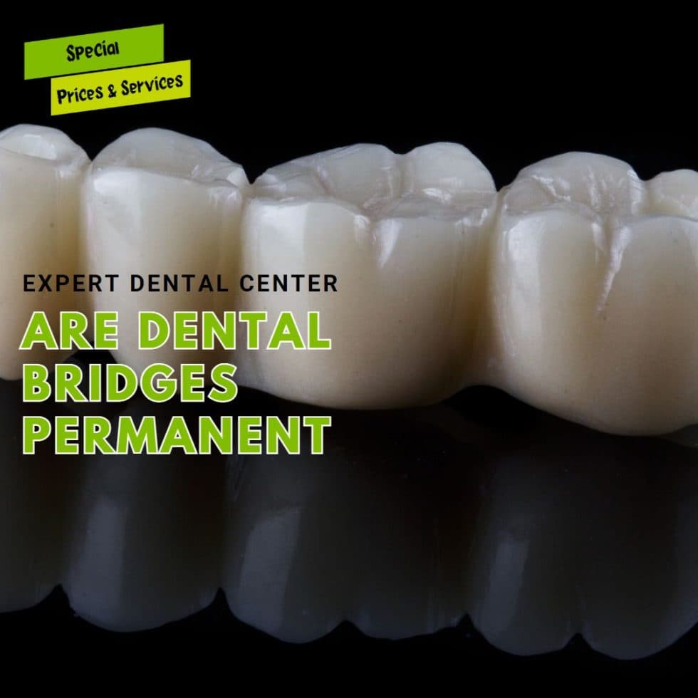 Are Dental Bridges Permanent?