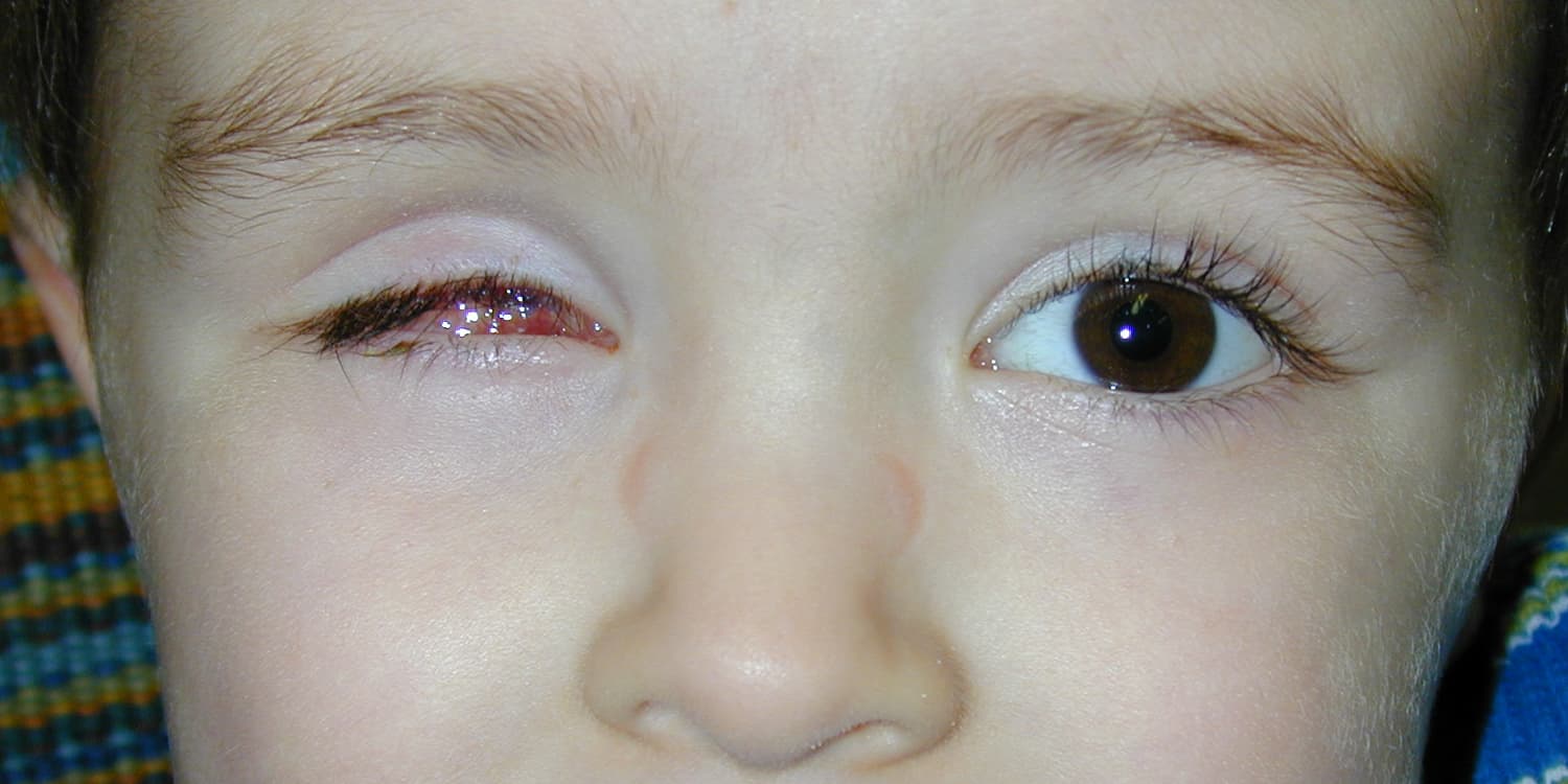 Ocular Prosthetics — Scott Fiscus, B.C.O.