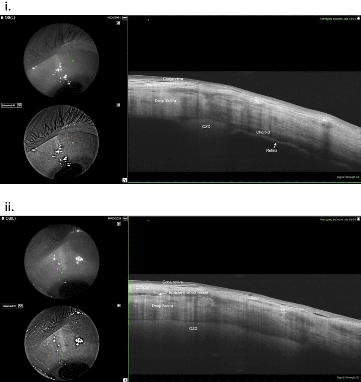 Suprachoroidal implantation of corticosteroid slow release ...