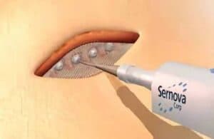 Sernova reports positive interim data for Cell Pouch System