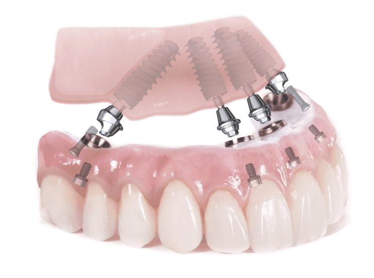 Permanent Teeth In A Day | Maryvale Denture Clinic